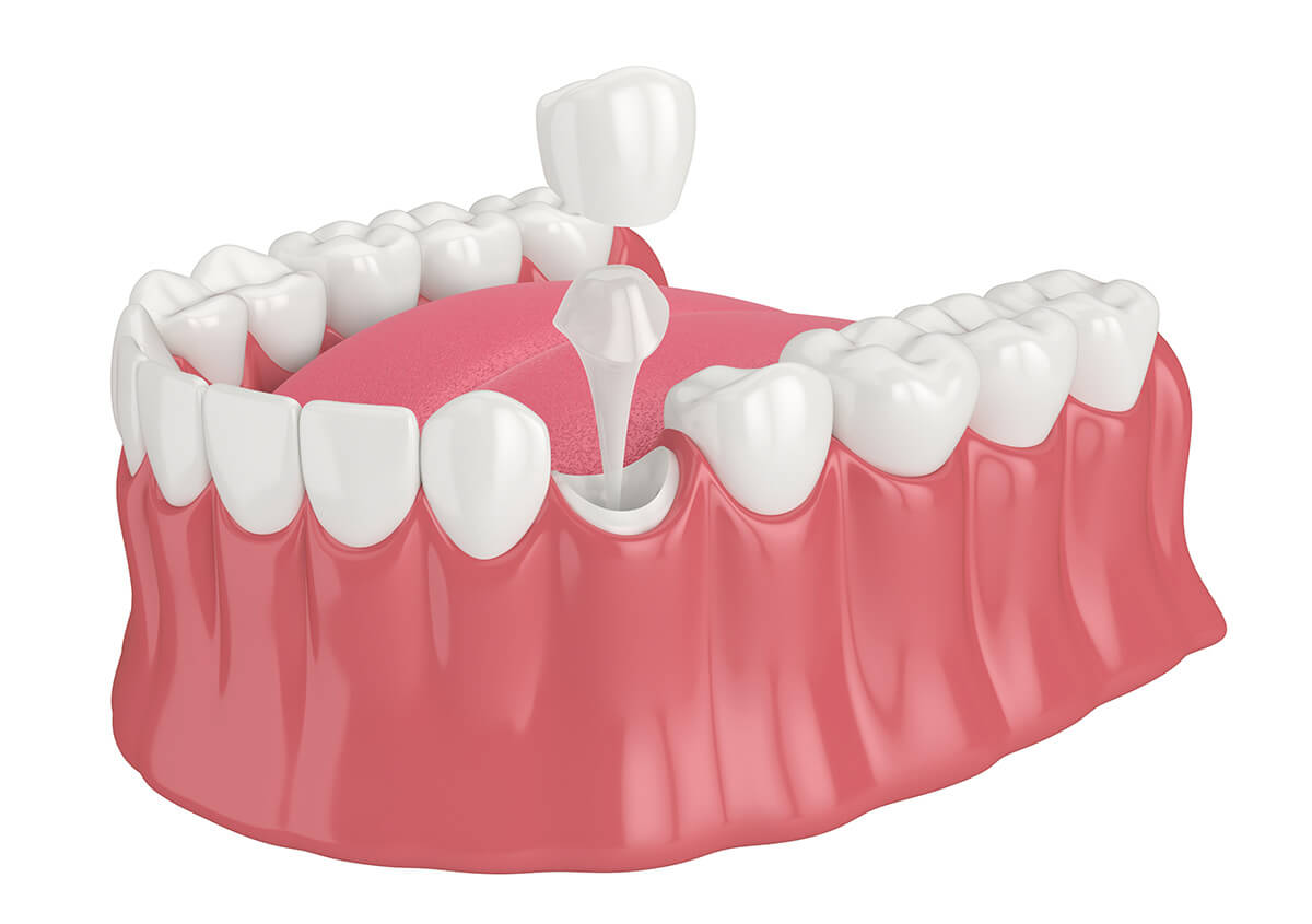 Crowns for Your Teeth in Garden Ridge TX Area