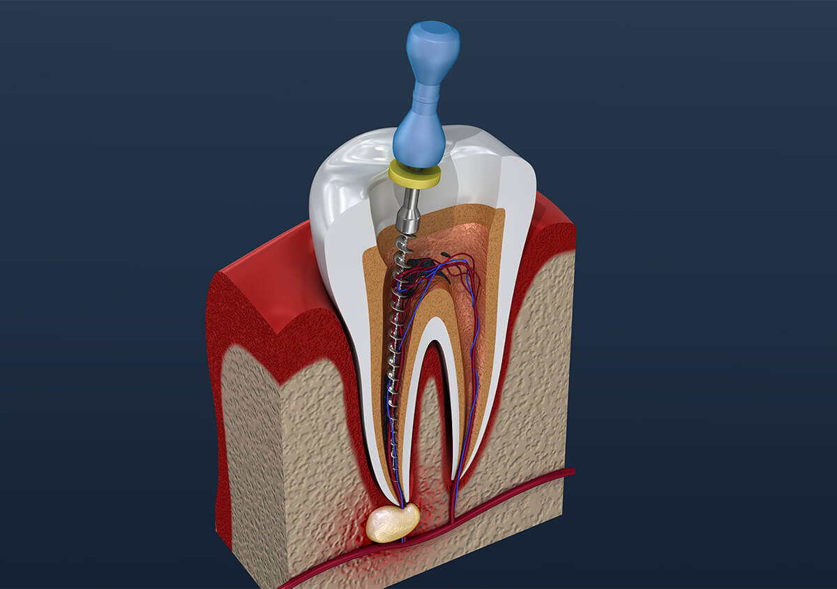 What is the Purpose of a Root Canal in Garden Ridge TX Area