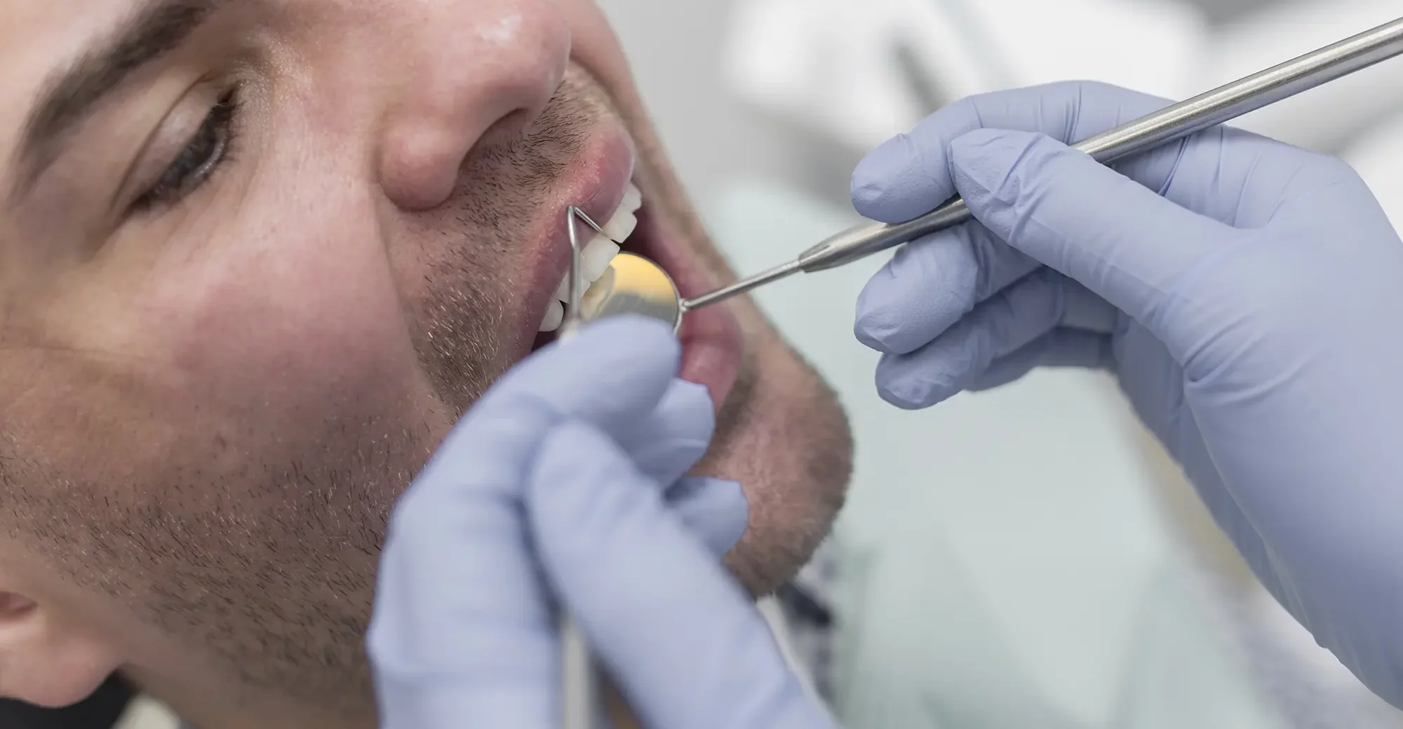 Cavities & Fillings