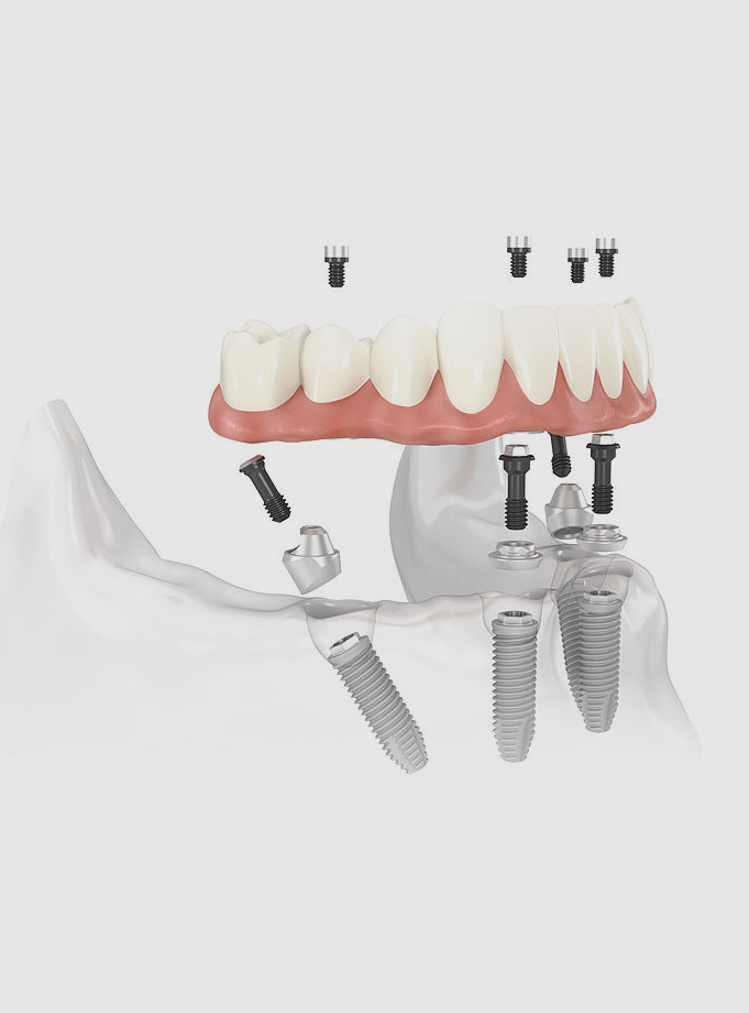 What to expect from All-on-4 dental implant treatment