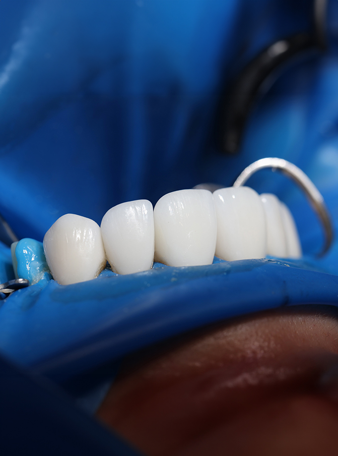 What is a dental bridge?