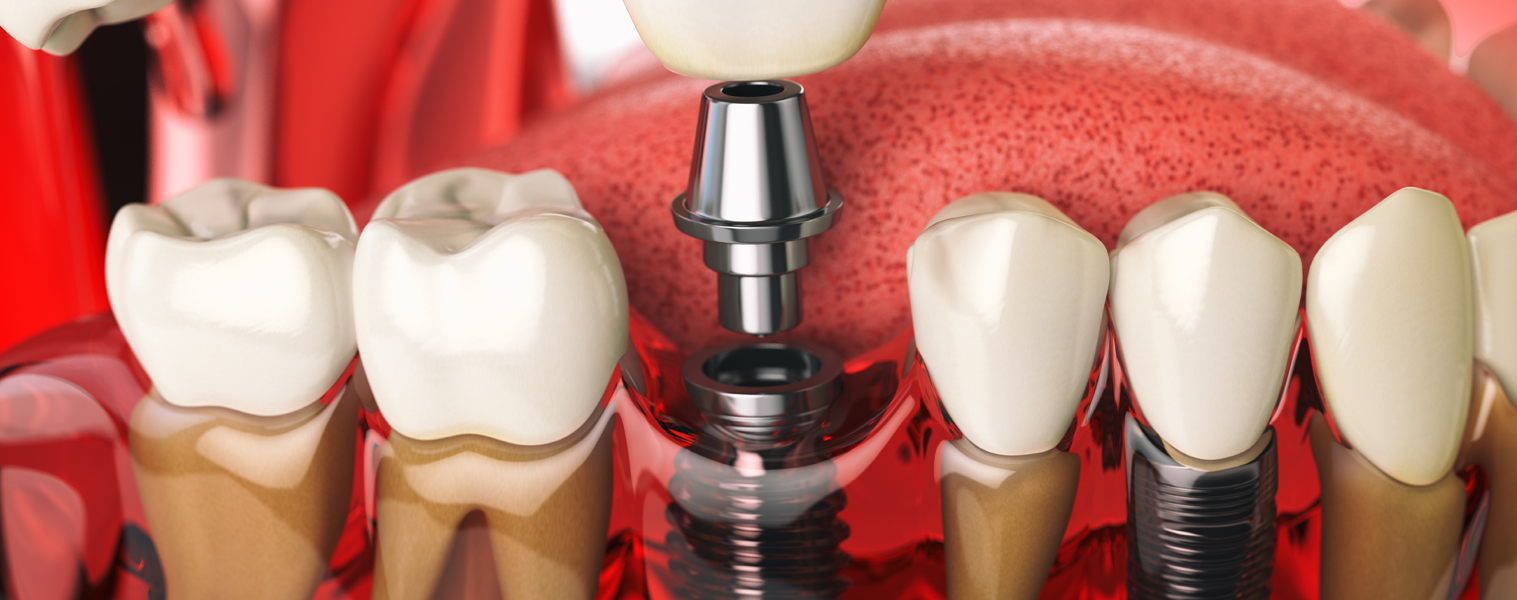Dental Implants