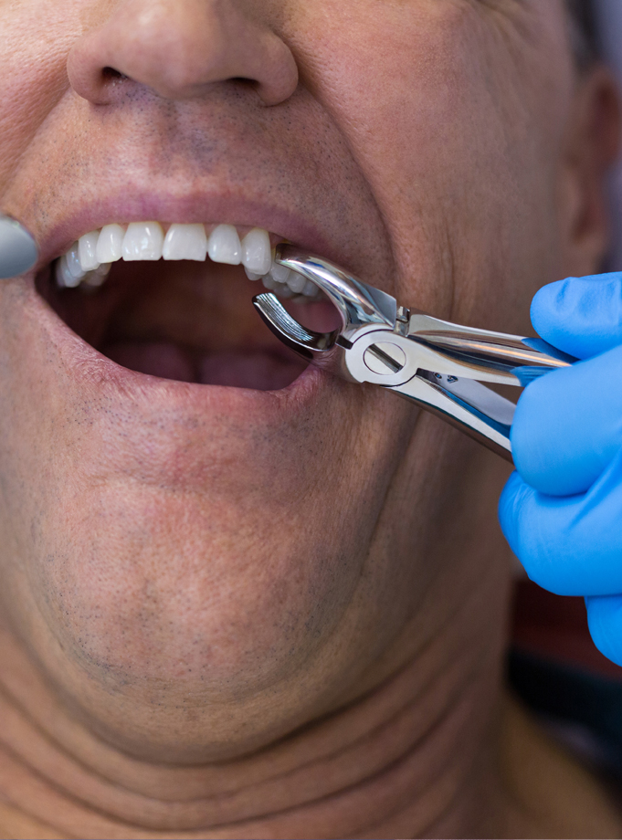 Extractions