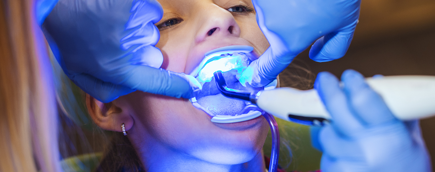 Teeth Whitening (by Kor®)